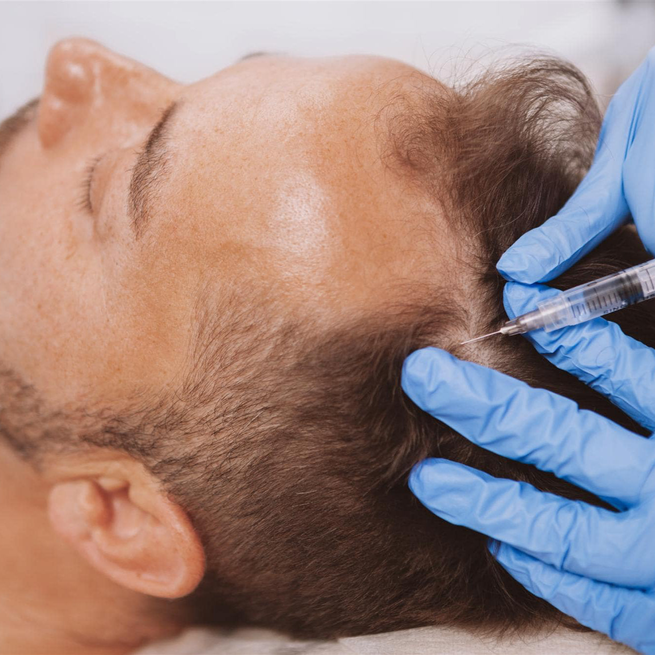 PRP/PRF Hair Restoration